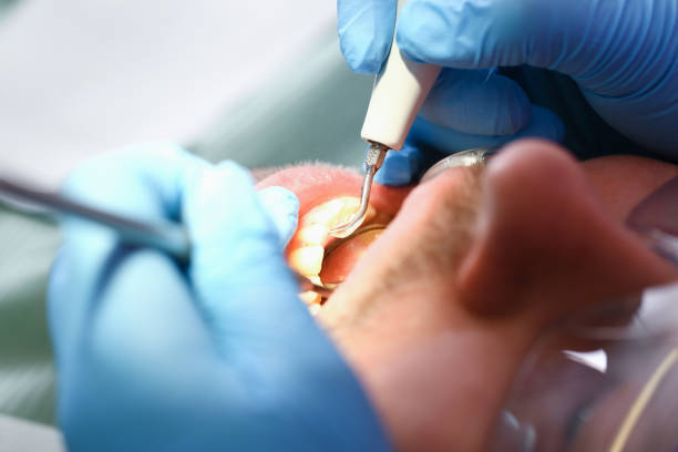 Best Emergency Dental Care for Abscessed Tooth in Chalfont, PA