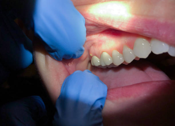 Best Broken or Cracked Tooth Emergency Dentist in Chalfont, PA